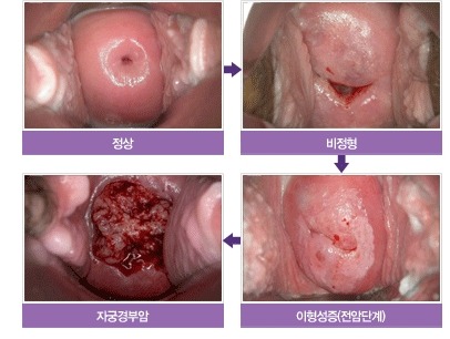 자궁경부암 사진.jpg (징그러움 주의) | 인스티즈