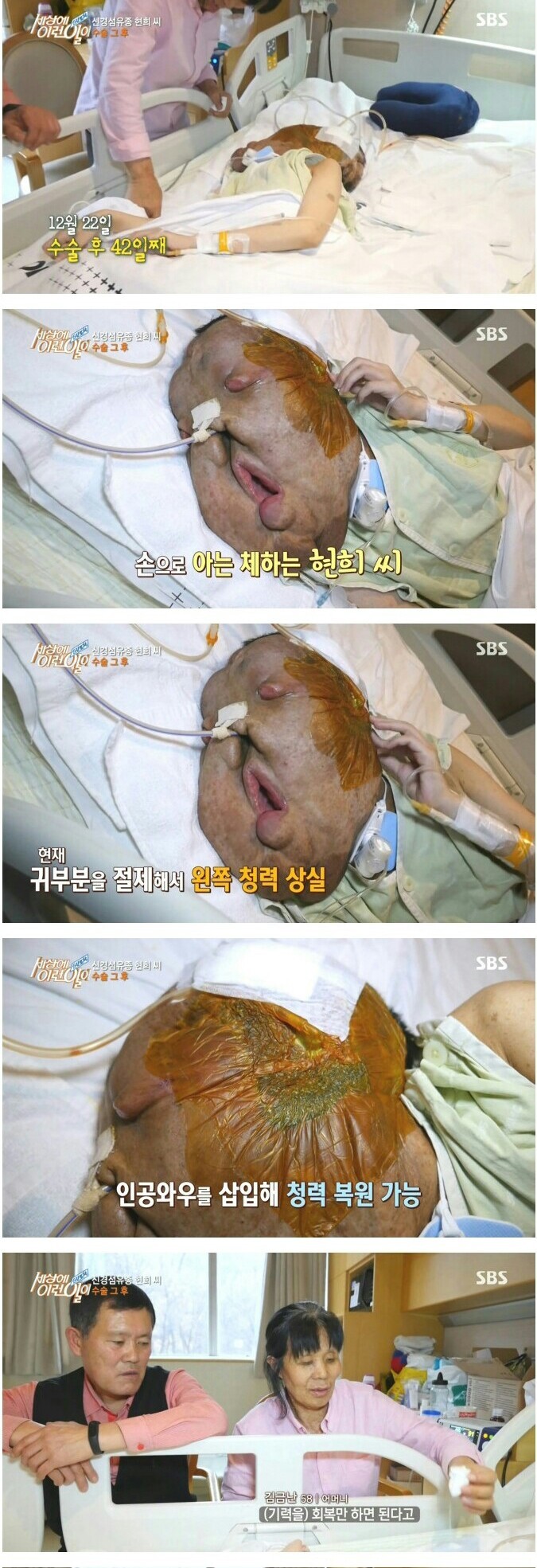  sbs 세상에 이런 일이 현희씨 수술 그 후.jpg | 인스티즈