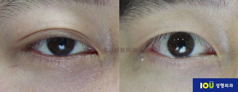 남자 쌍꺼풀 제거 수술 | 인스티즈
