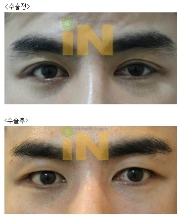 남자 쌍꺼풀 제거 수술 | 인스티즈